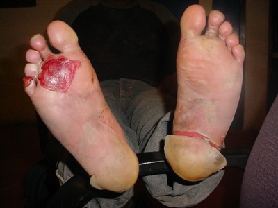 Border Patrol USBP miscellaneous modern injured alien feet pealing skin